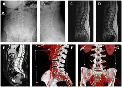 Case Report: A Rare Case of Fourth Ventricle to Spinal Subarachnoid Space Shunt Migration: Surgical Pearl and Literature Review